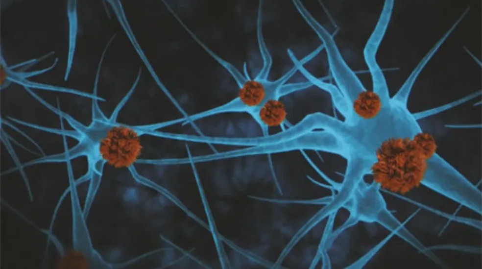 Droga retarda a progressão do Alzheimer em 60% para pacientes em estágios iniciais da doença
